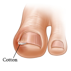 Ingrown Toenail