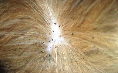 How To Get Rid of Fleas on Humans Naturally